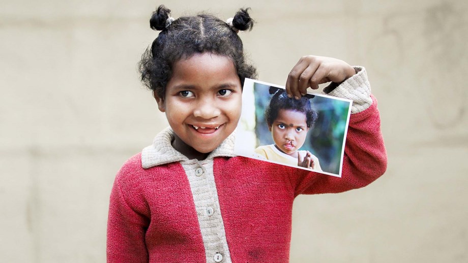 Girl holding picture of herself with cleft lip