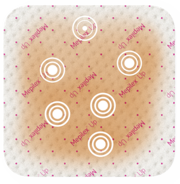 An illustration showing how the fluid have spread even more under a Mepilex Up wound dressing. 