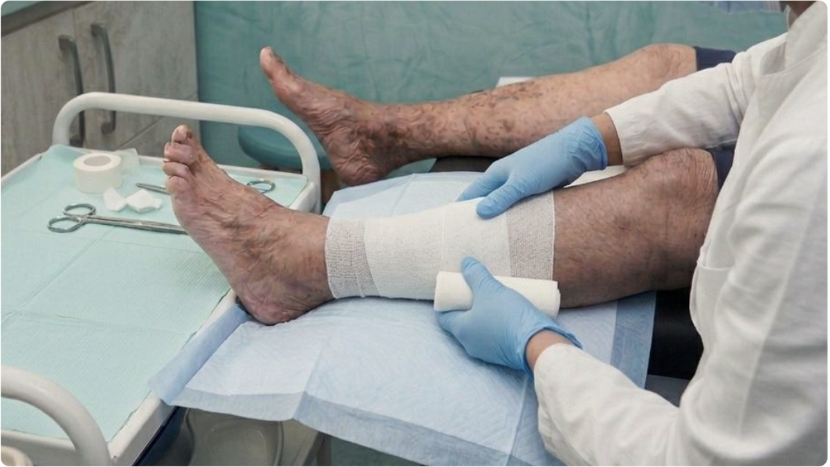 Venous leg ulcer management 