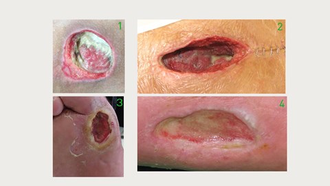 Wound types images