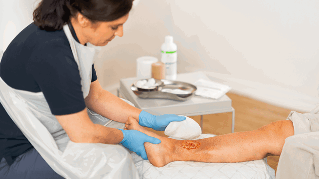 A photo of a nurse tending to the wound dressing on a leg. 
