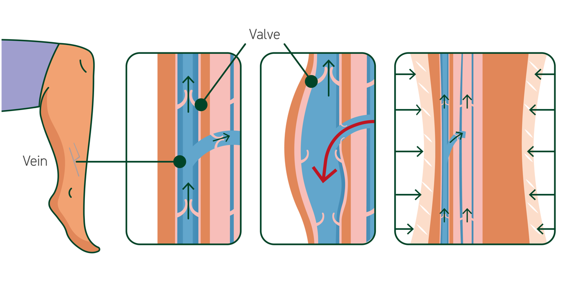 The cross-section of a leg: A healthy vein, a damaged vein and the effects of compression. Illustration.