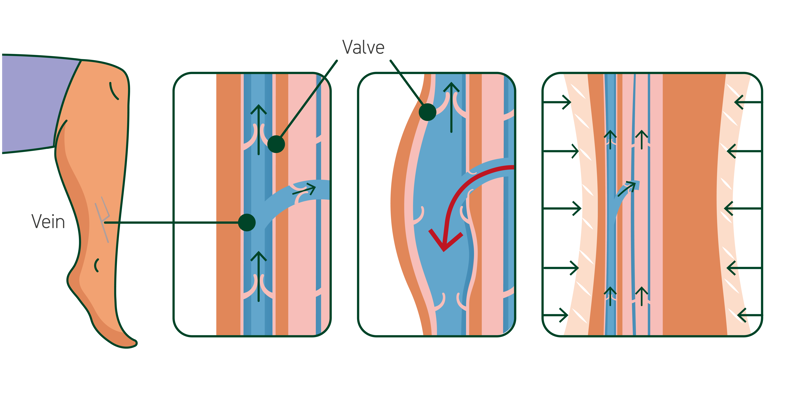 Images illustrating healthy and unhealthy veins in a leg