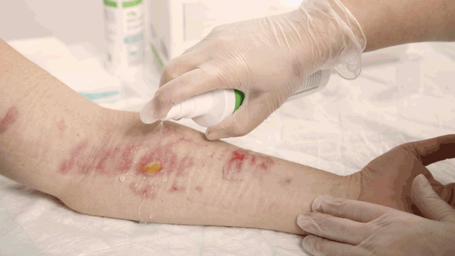 A photo of a wound being cleaned. 