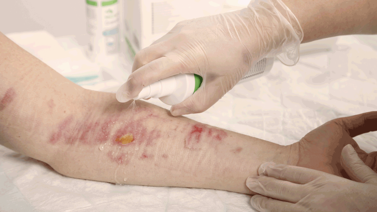 A photo of a wound being cleaned. 