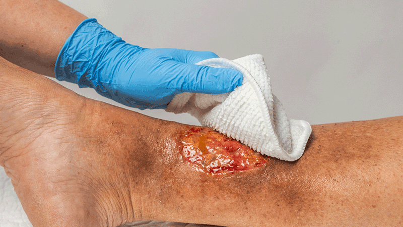 A photo of a hand using a Mepi Debripad on a leg ulcer.