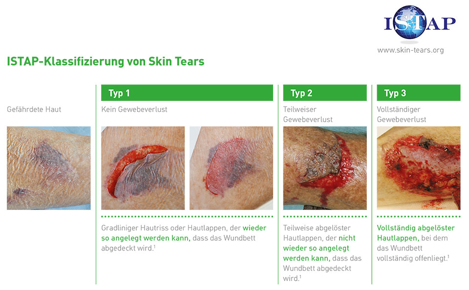 ISTAP-Klassifizierung-skin-tears.jpg