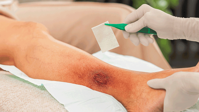 A photo of hands applying Exufiber Effect onto a leg ulcer. 