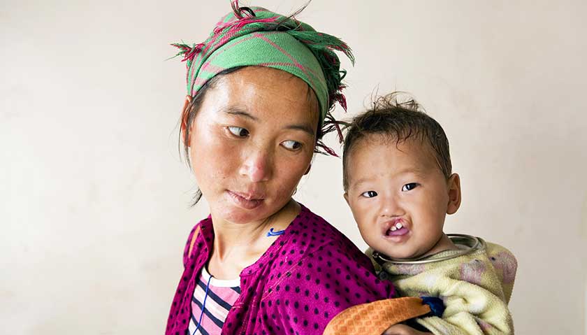 Operation Smile umożliwia świeży start dzieciom z deformacjami twarzy